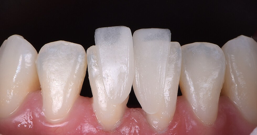 VITA ceramic layering example