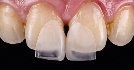 Ivoclar veneer example
