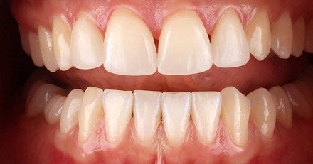 Ivoclar esthetic result